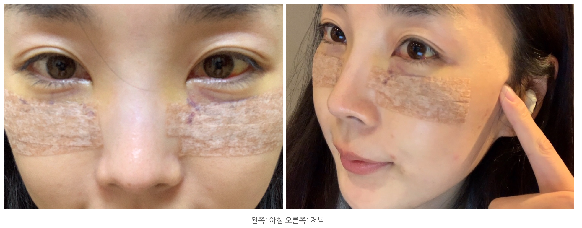 눈밑지방재배치 후기