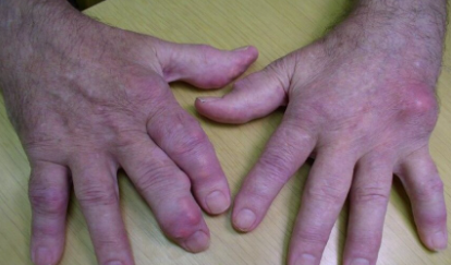 통풍 초기증상1