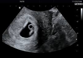 임신 7주차