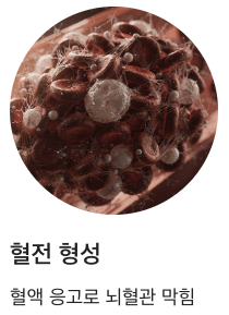 뇌졸중 전조 혈전 형성