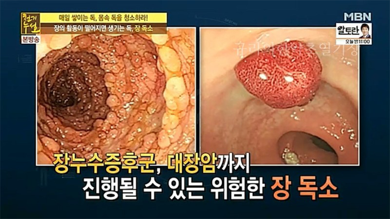 몸속 독소는 암에 걸릴 수 있다