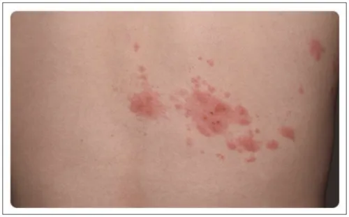 대상포진 치료기간