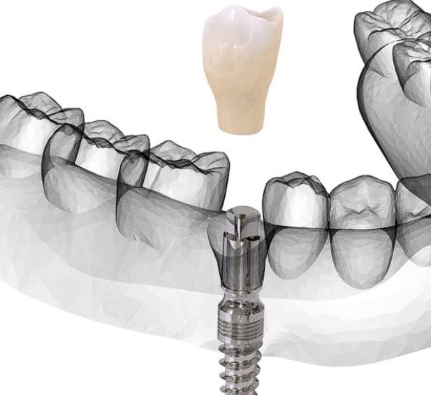 상악동거상술-비용