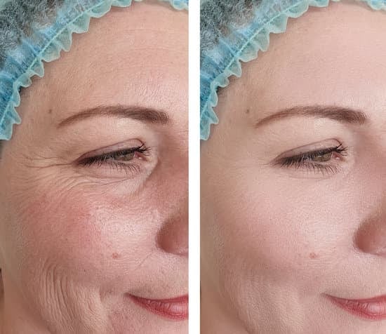 주름 개선 시술