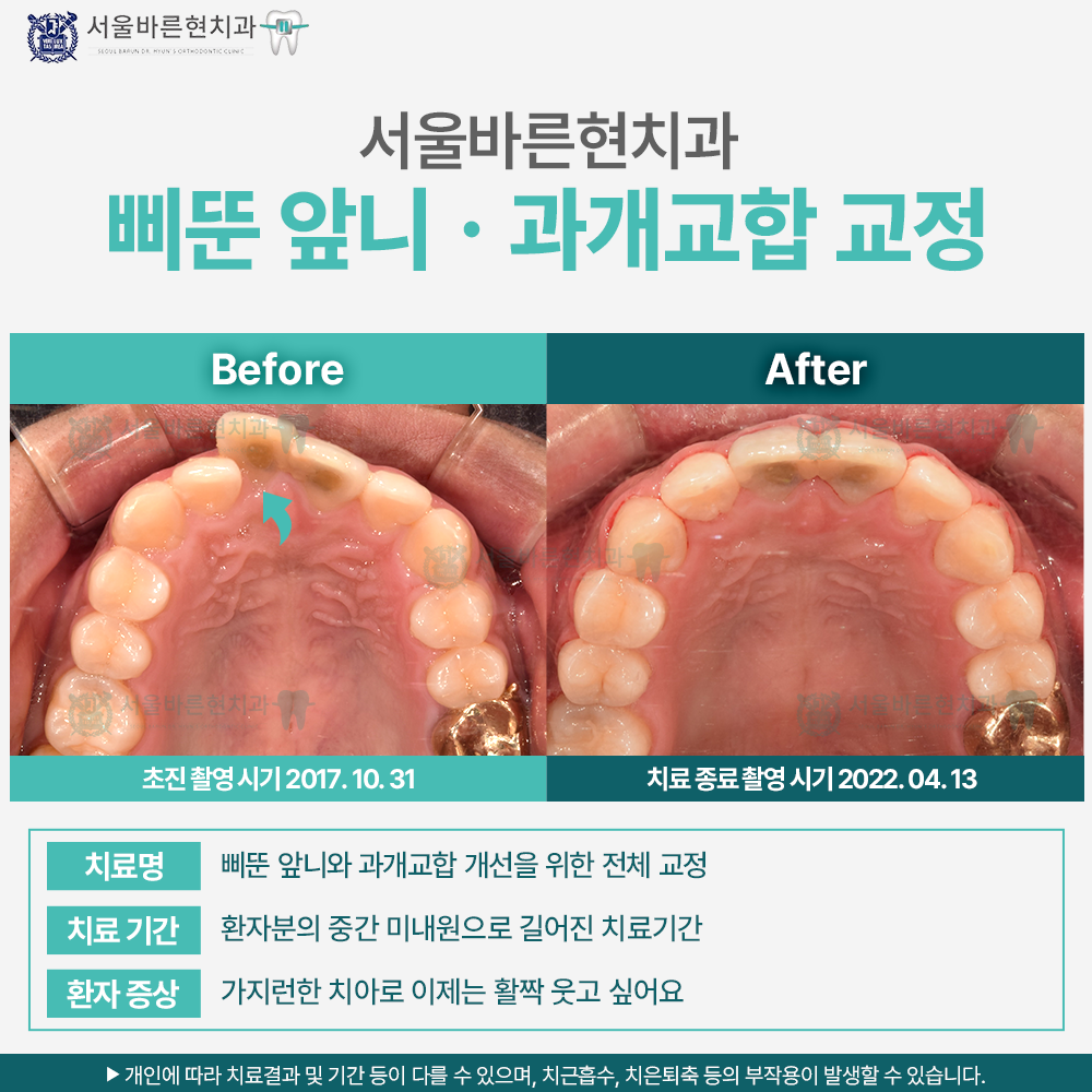 해운대비발치교정