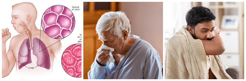 폐렴 관련 사진 3개