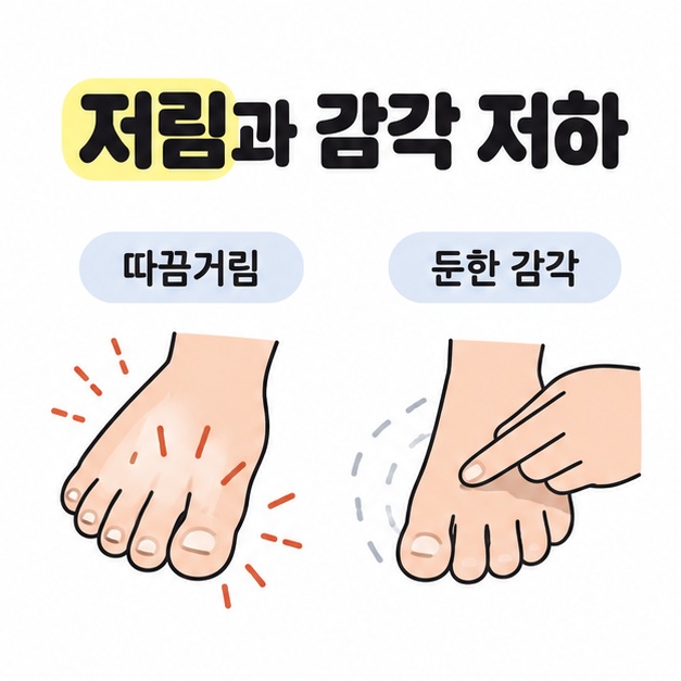따끔거리는 발의 감각 표시와 발등을 가볍게 만져도 감각이 둔한 상황을 비교한 그림