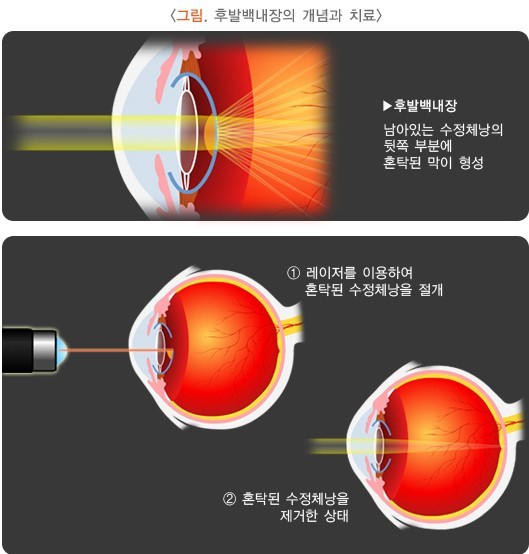 백내장