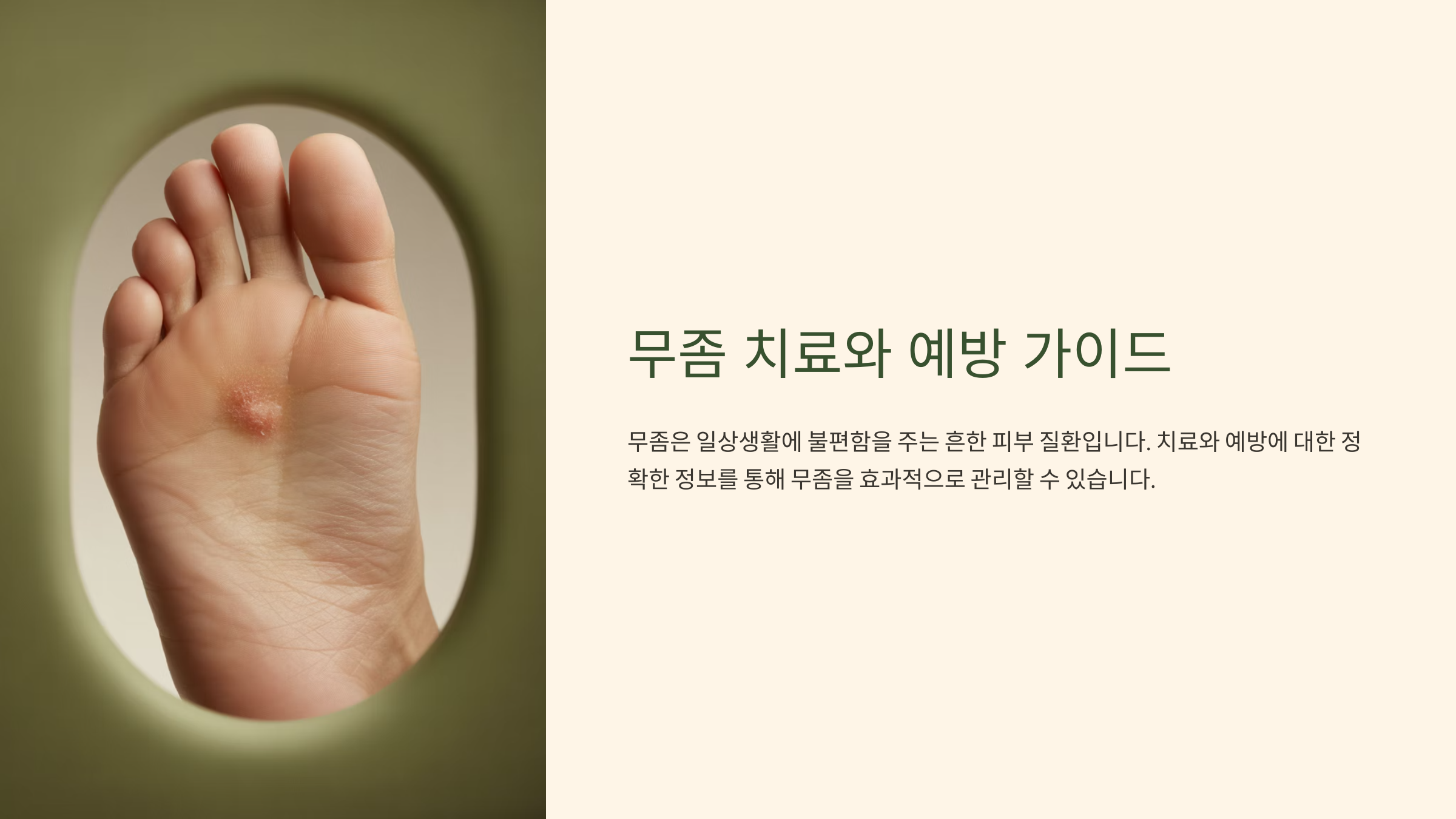 무좀 치료와 예방 가이드