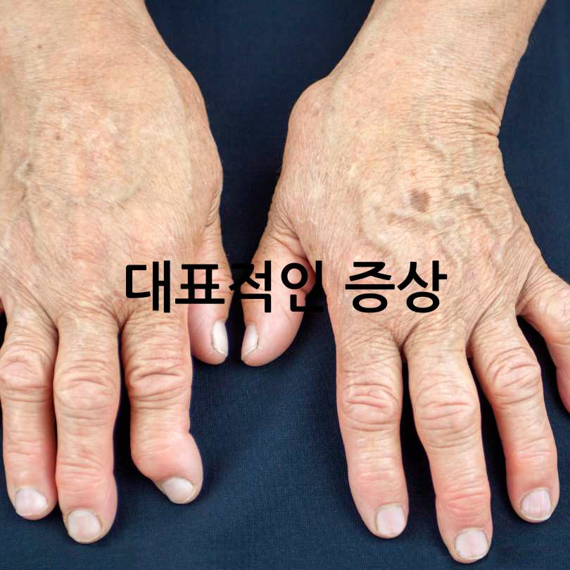 류마티스관절염 증상,식단,운동법