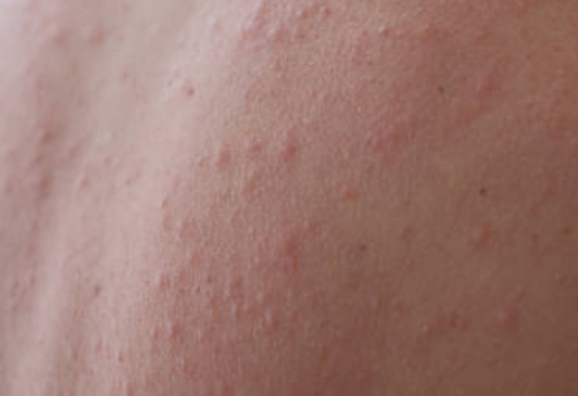 모공을 중심으로 등에 발생한 두드러기