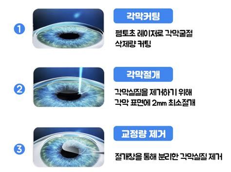 난시 라식