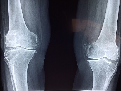 턱관절 통증 소리 치료방법 (실제후기)