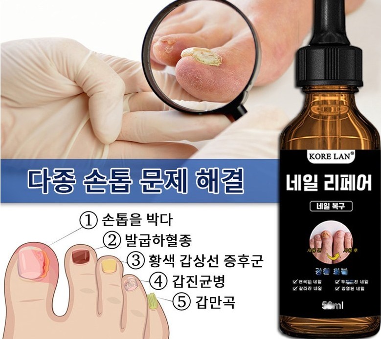발톱무좀약