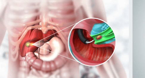 담낭염의 증상, 담낭 용종