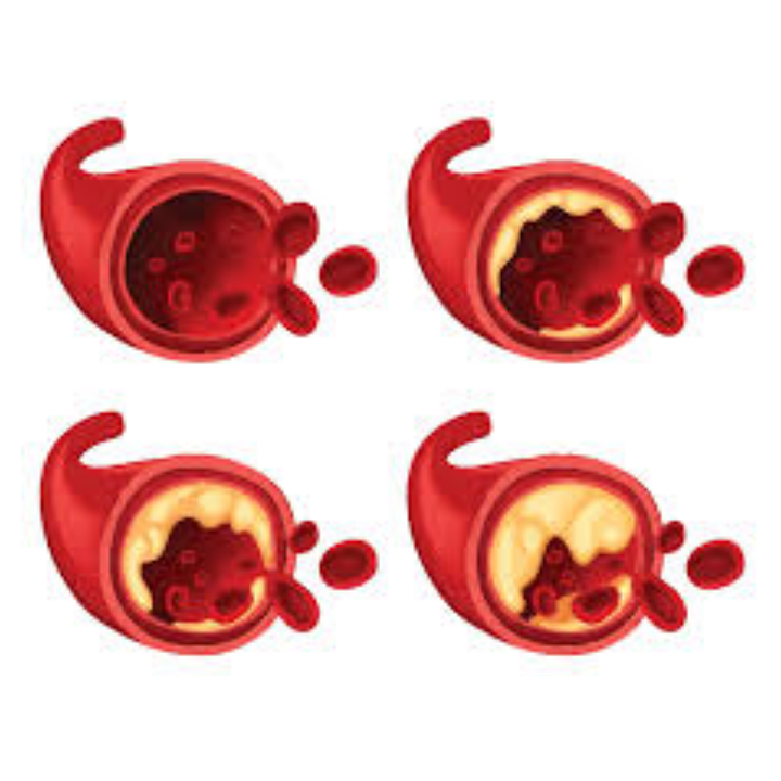 점점 혈관이 막혀 동맥경화가 발생하는 모습