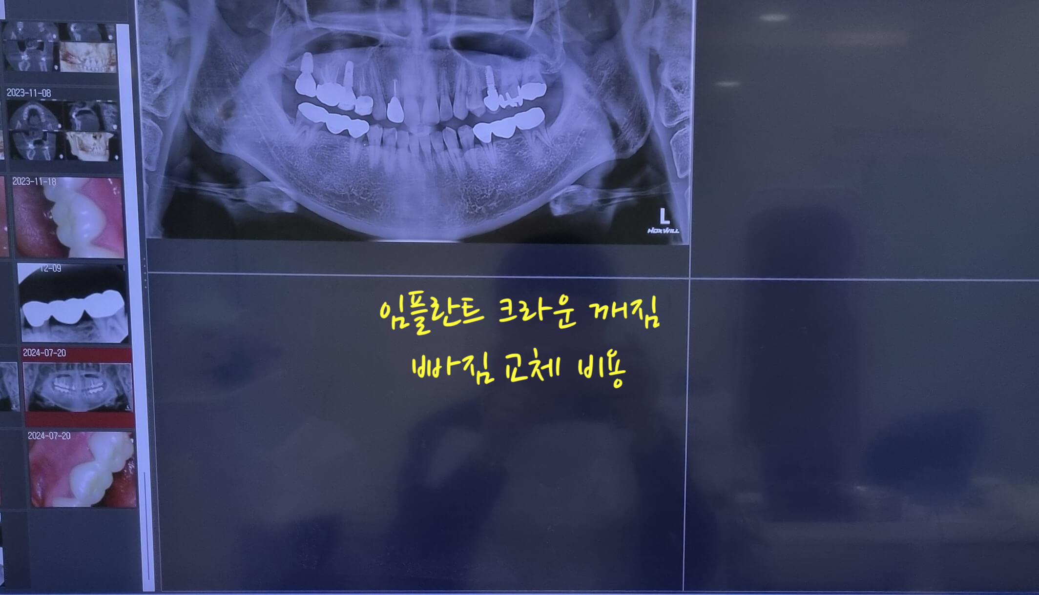 임플란트 크라운 깨짐