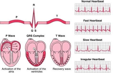심장질환 환자 ECG(심전도) 판독법과 주요 간호