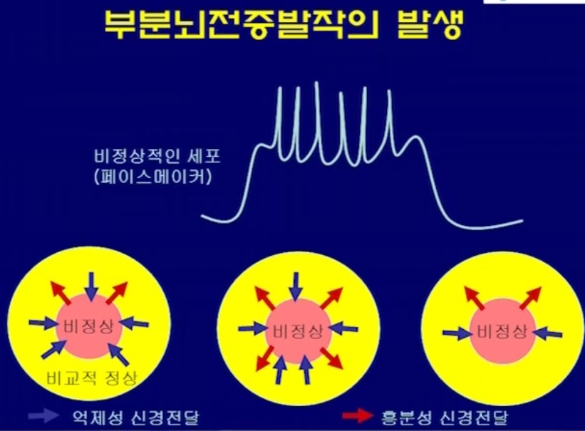 뇌전증-원인