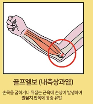 팔꿈치 통증 8