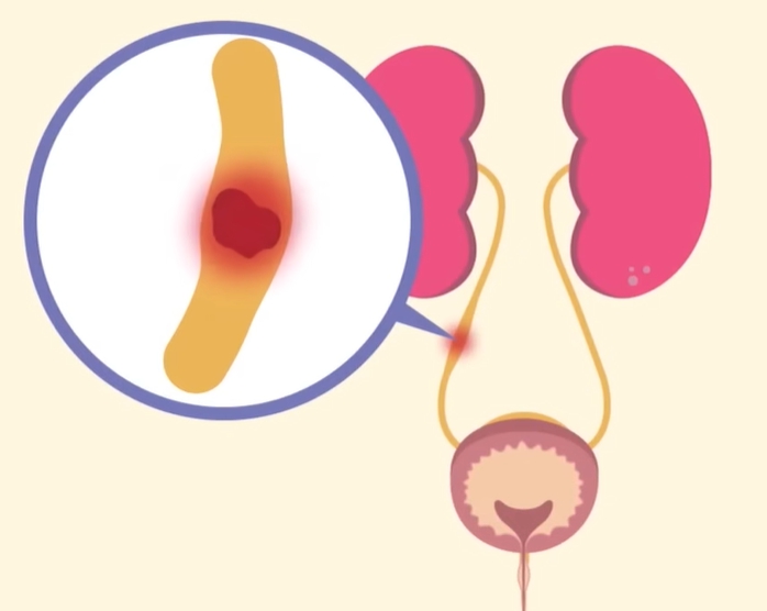 급성 신우신염 증상