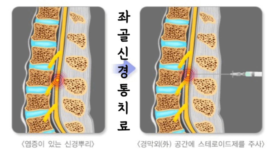 좌골신경통치료-스테로이드주사