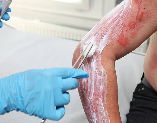 저온화상 초기 응급처치 방법