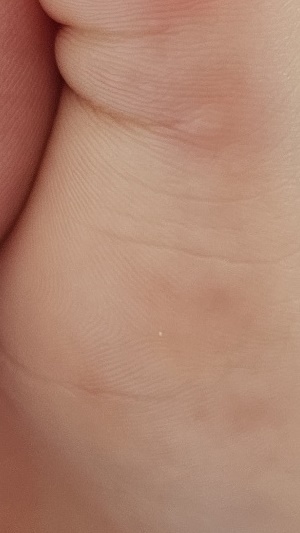 수족구병 증상 격리기간