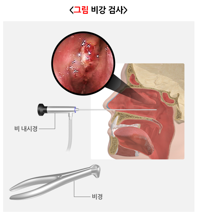 축농증수술