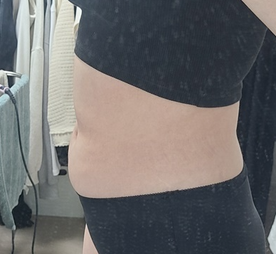 복부지방흡입 후기