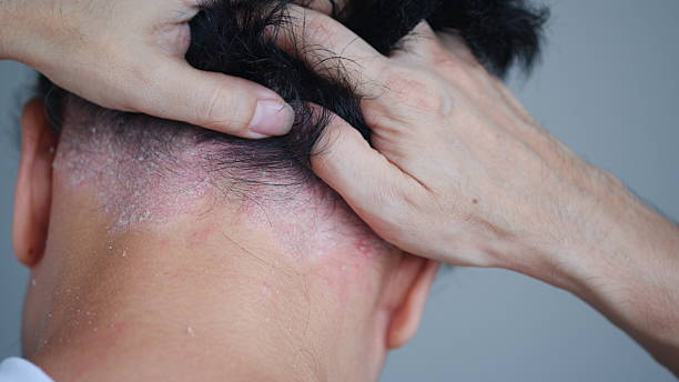 비듬이 생기는 원인은 단순히 두피 각질이 떨어지는 현상이 아닙니다