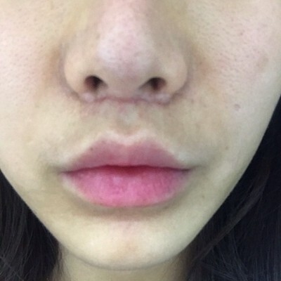 인중 축소 수술 후기