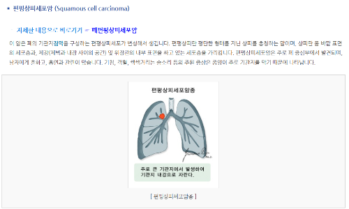 편평상피세포암 (Squamous cell carcinoma)
