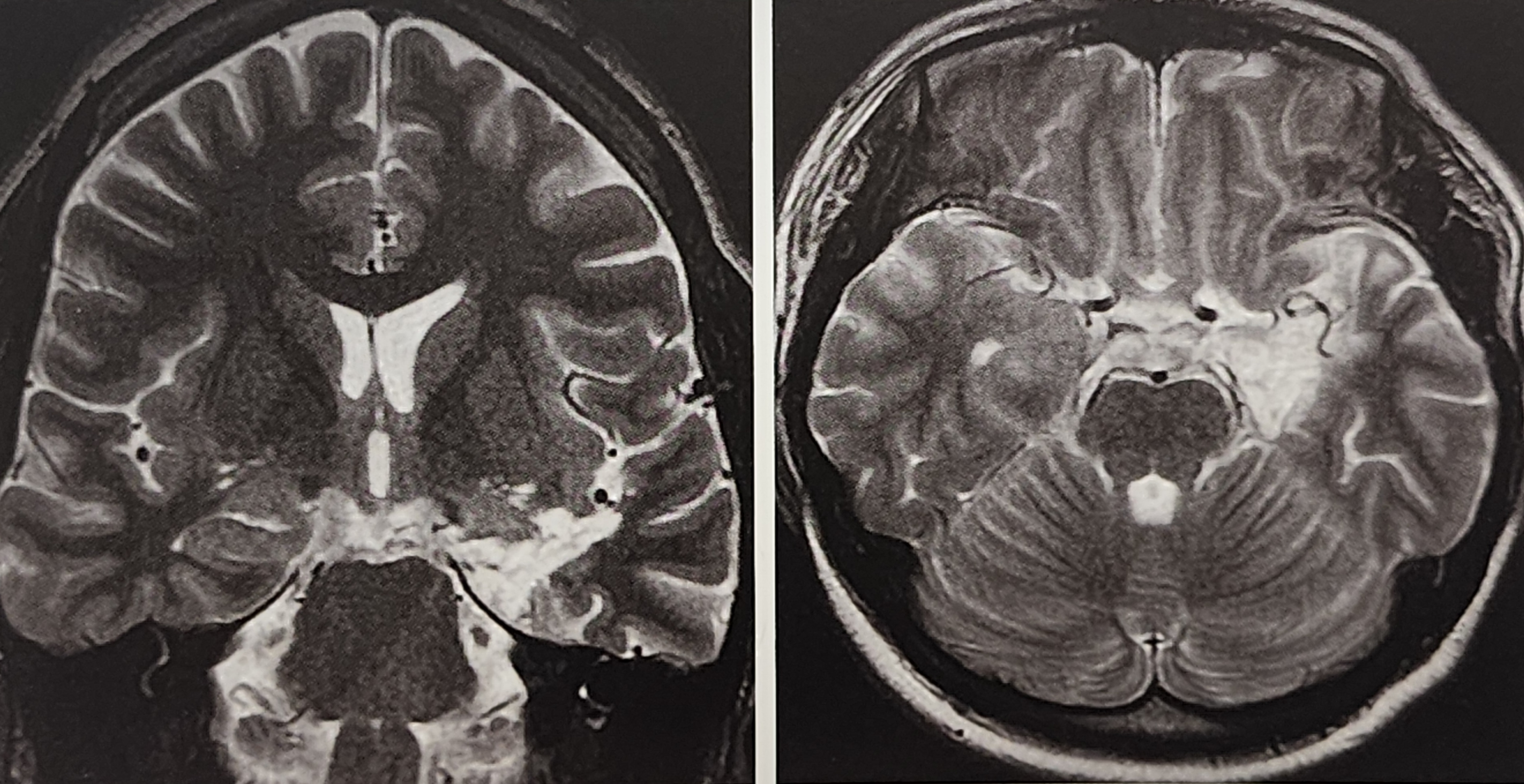 측두엽 뇌전증과 측두엽 절제술