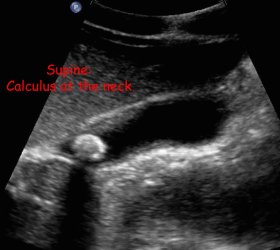 담석증 (Cholelitiasis = GB stone)