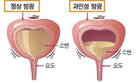 과민성-방광-이유