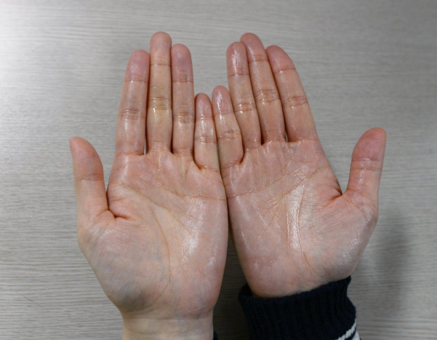 양쪽 손바닥에 땀이 흥건히 나는 수지다한증 환자의 손바닥을 바닥에 펼쳐 놓고 찍은 사진