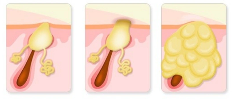 화농성 한선염 증상의 진행 과정