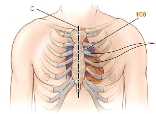 정중흉골절개