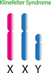클라인펠터 증후군, 남자가 유방이 나온다면? 대표적인 증상입니다. 클라인펠터 증상은 다양하게 더 있습니다. 어떤 증상과 원인 그리고 진단과 치료에 대해 알아봤습니다. 참고하시기 바랍니다.