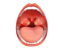 편도염 빨리 낫는법