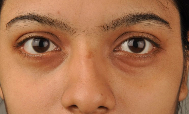 다크서클에좋은음식 추천