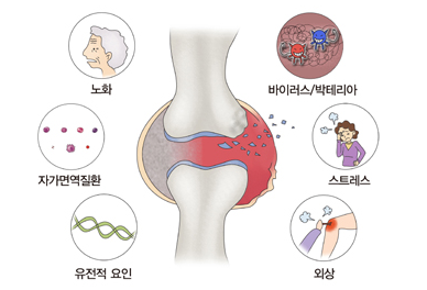 관절염 원인