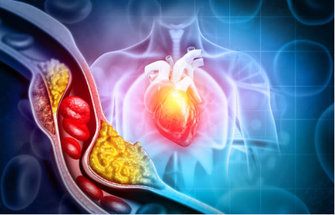 고지혈증 조용한시한폭탄