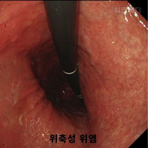위축성 위염 진단 치료