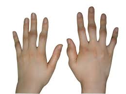 손가락 관절염 초기증상