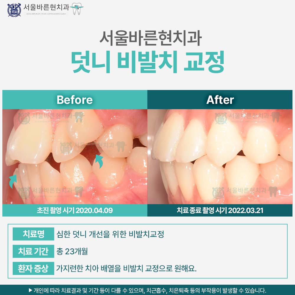 부산치아교정