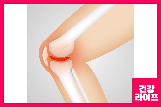 무릎 통증 증상