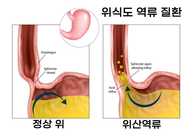 속이 쓰린 이유 속쓰림 원인 위산역류 역류성식도염
