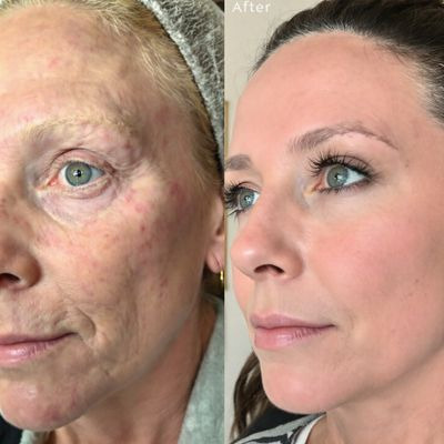  하이드로퀴논 기미 잡티 완화 효과2